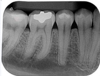 periapical periapical